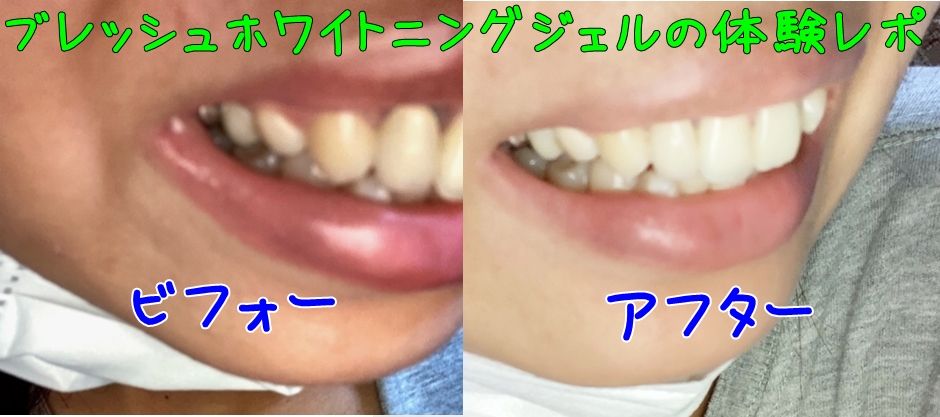 歯 を 白く する 市販